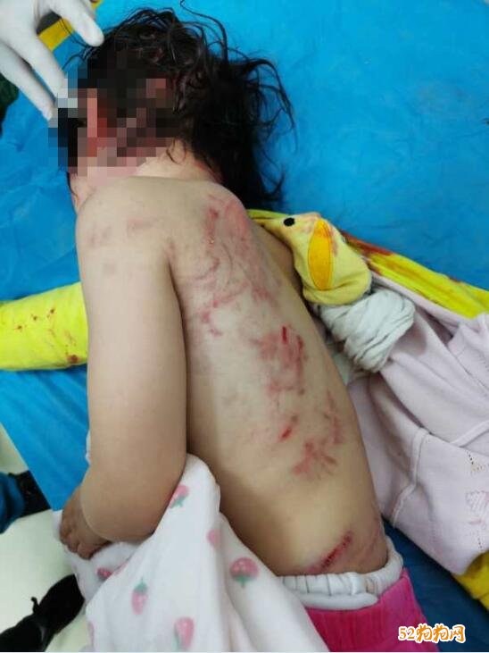 可怜！广西一4岁女童被狗撕咬伤痕累累详尽历经！